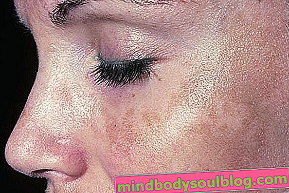 טיפולים להסרת כתמים כהים על העור