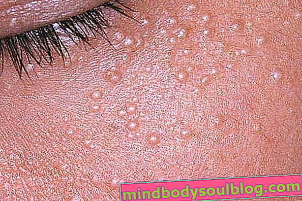 Qu'est-ce que le milium sur la peau, les symptômes et comment l'enlever