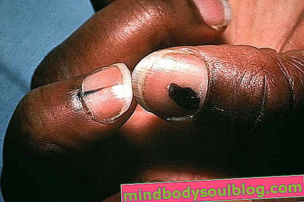 Що таке меланома нігтів, симптоми та лікування