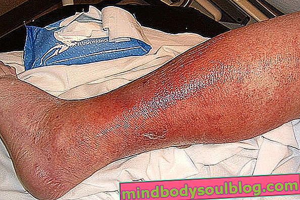Hautinfektion: Haupttypen, Symptome und Behandlung