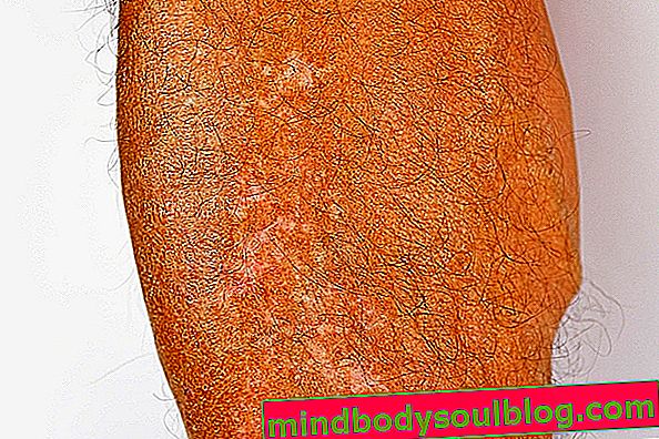 Leucoderma gutata (weiße Sommersprossen): Was es ist und wie es zu behandeln ist