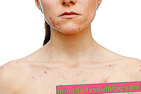 Les meilleurs traitements pour chaque type d'acné