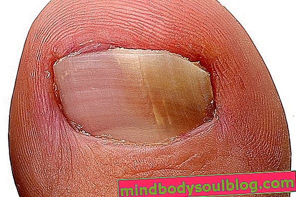 Co to jest grzybica paznokci (grzybica paznokci), objawy i sposób leczenia