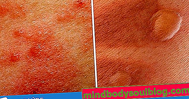 Cara menghilangkan 8 jenis tompok kulit yang paling biasa