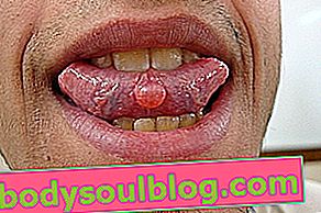 Mukozele unter der Zunge
