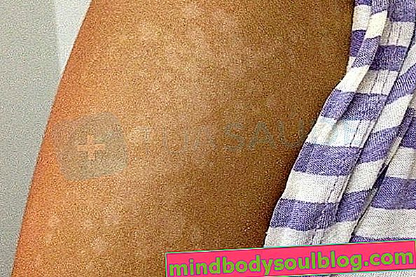 7 סוגים של גזזת של העור ואיך לטפל 