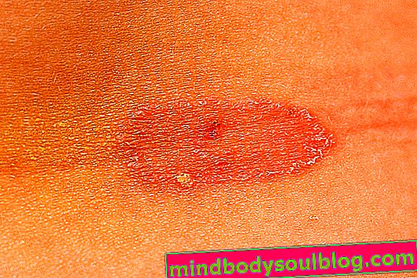 7 סוגים של גזזת של העור ואיך לטפל