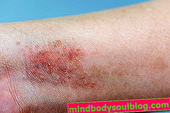 Was ist Dermatitis und was sind die verschiedenen Arten