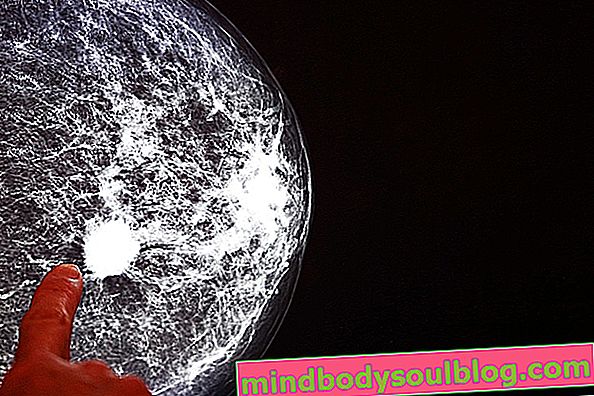 Apa itu fibroadenoma payudara dan apa hubungannya dengan barah