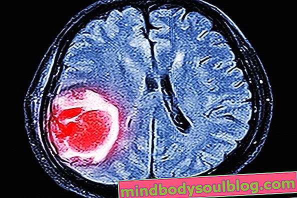 أنواع أورام المخ وعلاجها وعواقبها المحتملة