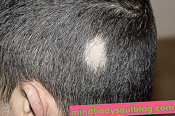 円形脱毛症を特定して治療する方法