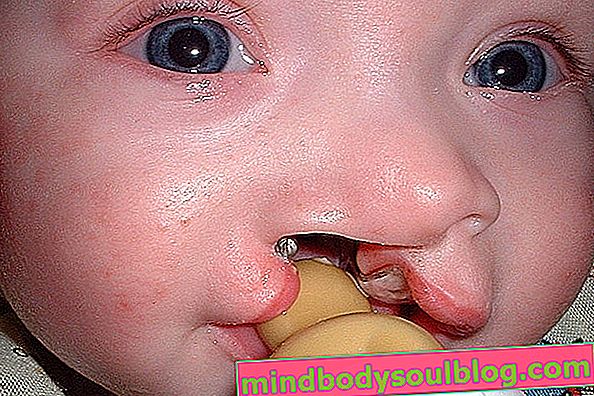 Photo d'un bébé atteint du syndrome de Patau