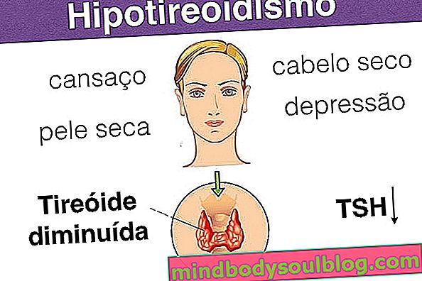 Gejala hipotiroidisme, penyebab utama dan bagaimana pengobatannya