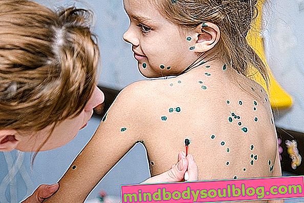 7 questions courantes sur la varicelle