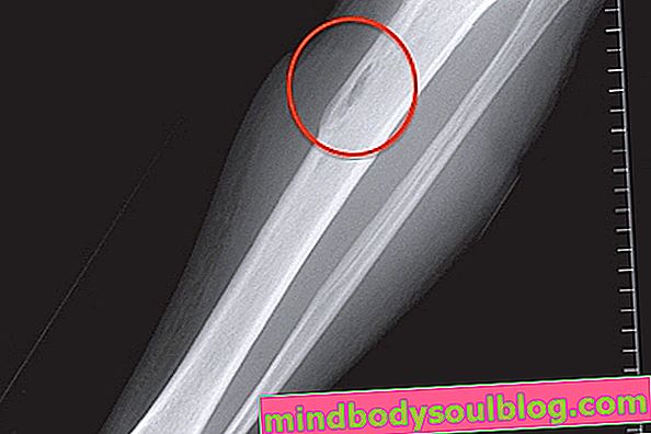 צילום רנטגן של עצם הזרוע עם אוסטאומיאליטיס