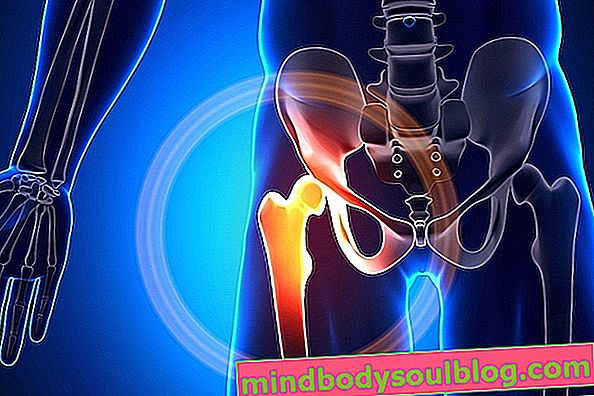 Arthrose de la hanche: qu'est-ce que c'est, symptômes et traitement