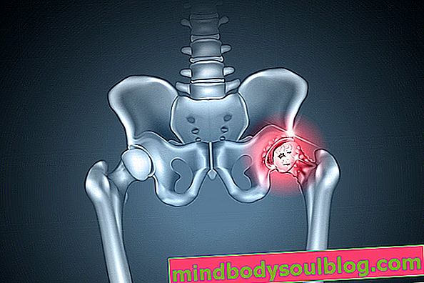 Arthrose de la hanche: qu'est-ce que c'est, symptômes et traitement