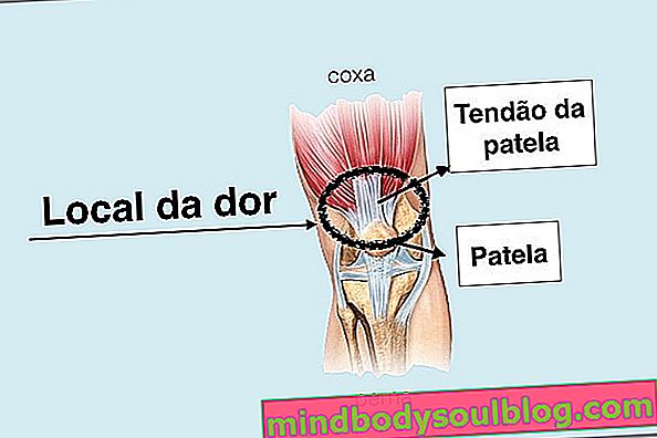 Tendonitis di lutut (patela): gejala dan pengobatan