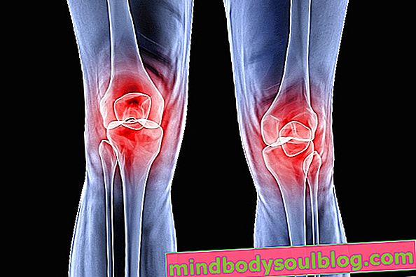 Schmerzen vor dem Knie können Chondromalazie sein