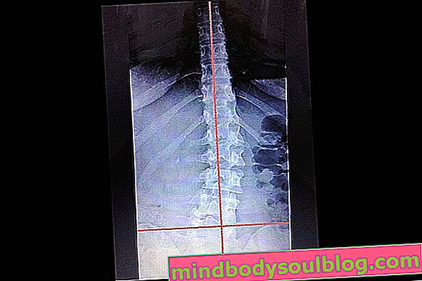 脊柱側弯症とは何か、種類と治療方法