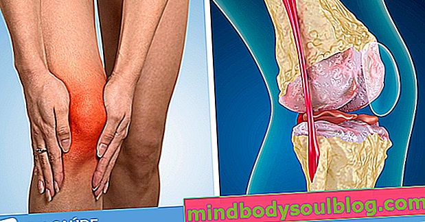 Как да идентифицираме и лекуваме артроза на коляното
