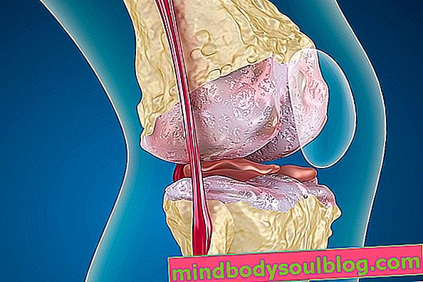Bagaimana Mengidentifikasi dan Mengobati Arthrosis Lutut