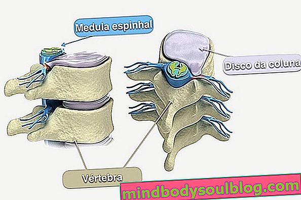 Traitement des fractures de la colonne vertébrale