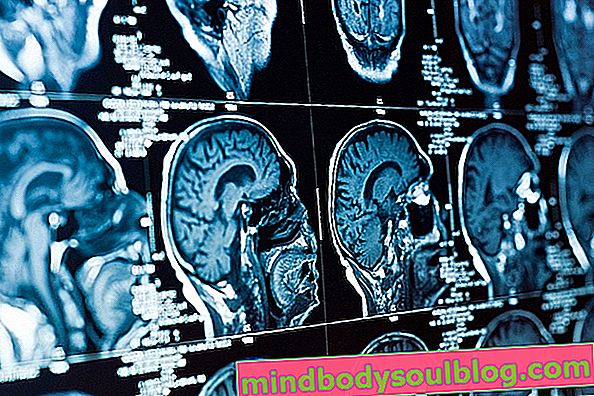 التهاب الدماغ المناعي: ما هو وأسبابه وعلاجه