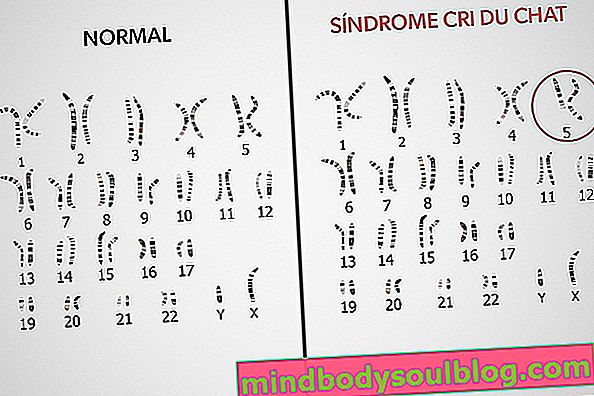Cri du Chat Syndrome：それが何であるか、原因と治療