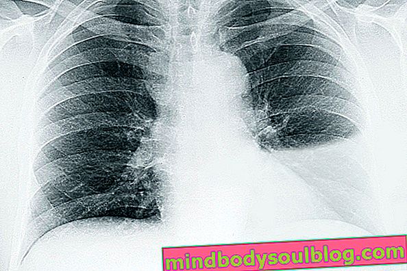Рентгенова снимка с плеврален излив от лявата страна