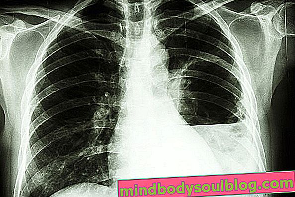 Was ist Lungenabszess, Symptome, Ursachen und wie zu behandeln