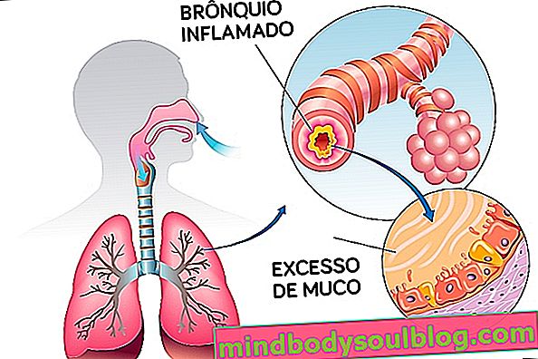 Bronkus yang meradang dan lendir yang berlebihan berhubungan dengan asma