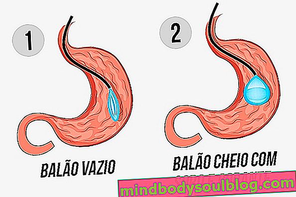 胃のバルーンが体重を減らすためにどのように機能するか