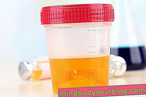 Urobilinogène dans l'urine: ce que cela peut être et que faire