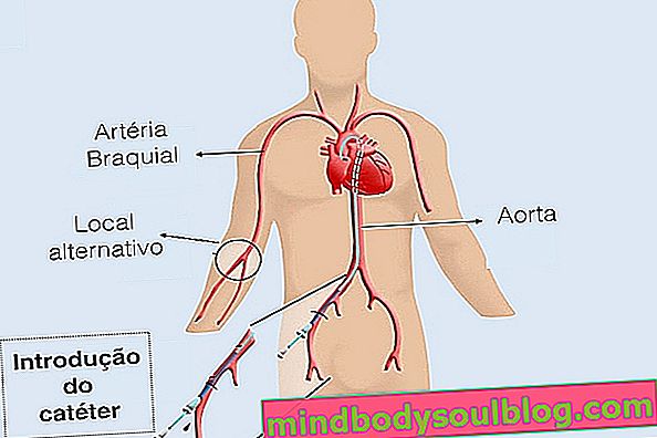 Comment se fait le cathétérisme cardiaque