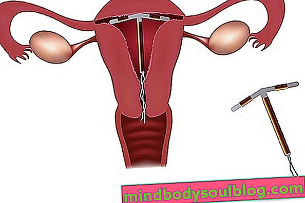 מירנה או IUD נחושת: יתרונות מכל סוג ואופן פעולתם