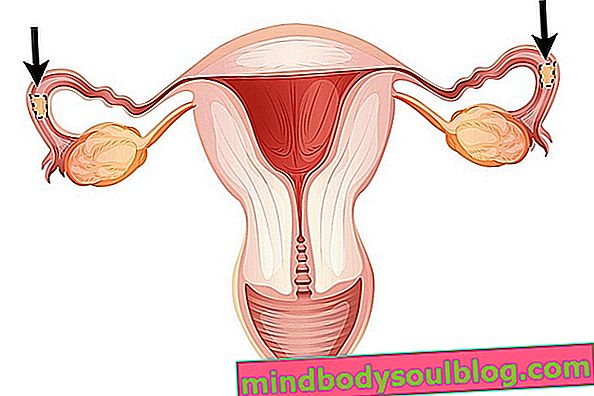 妊娠するための卵管閉塞の治療方法