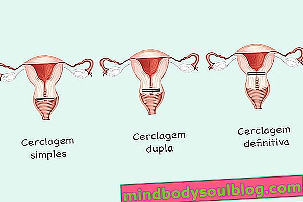 Cerclage uterus: Apa itu pembedahan dan bagaimana cara menggendong bayi