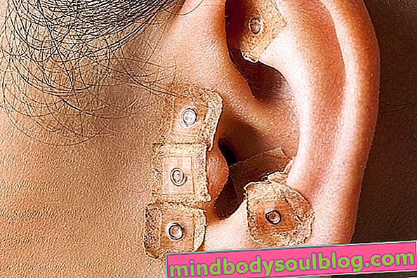 Akupunktur telinga