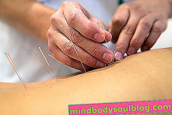 Avantages pour la santé de l'acupuncture