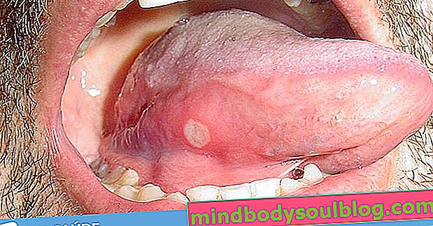 Sakit dingin di lidah: cara menyembuhkan lebih cepat dan penyebab utama