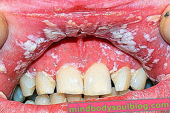 口腔カンジダ症とは何か、症状と治療方法