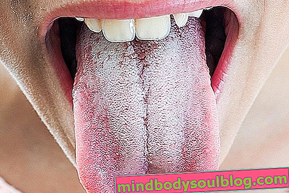 舌サブラーとは何ですか、主な原因と治療