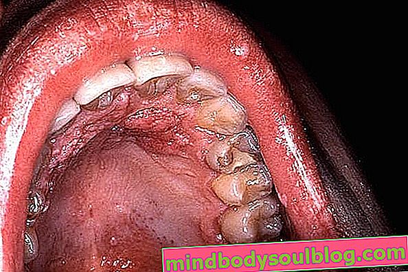 วิธีระบุและรักษา HPV ในช่องปาก