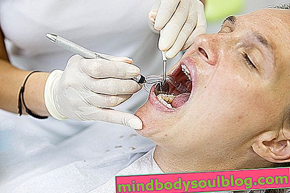 歯石を特定して予防する方法