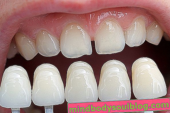 樹脂または磁器製の歯科ベニア：利点と欠点