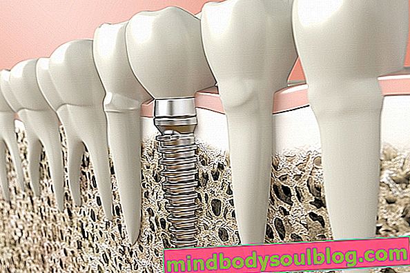 Zahnimplantat: Was es ist, wann es platziert werden muss und wie es gemacht wird
