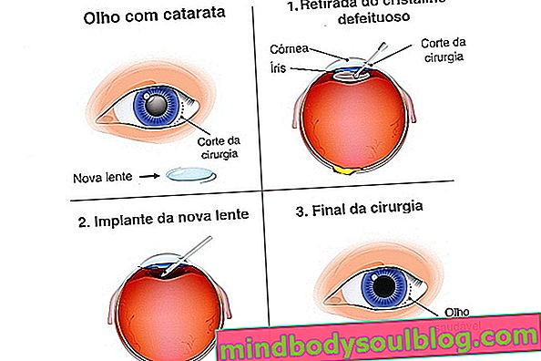 Opération de la cataracte