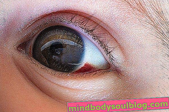 Червено петно ​​на окото: 6 възможни причини и какво да се прави