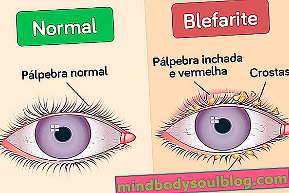 Apa itu blepharitis (kelopak mata bengkak) dan cara mengobatinya
